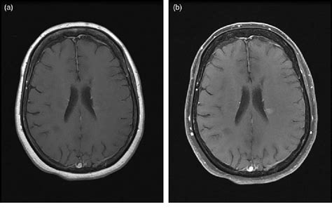 Fat Saturated Post Gadolinium T1 Imaging Of The Brain In Multiple