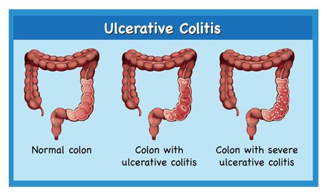 What Are The Different Types Of Ulcerative Colitis Diseases