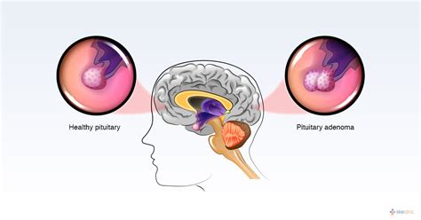 Pituitary Tumors Symptoms Treatment Causes Types And Diagnosis