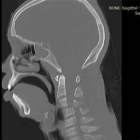 Cervical Spine Ct Sagittal Bone Window Showing C3 On C4 Anterior