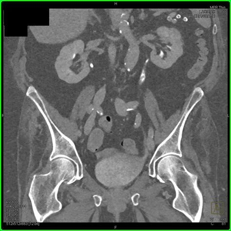 Transitional Cell Carcinoma Left Ureter Kidney Case Studies Ctisus