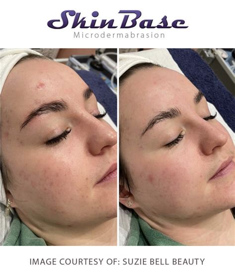 Microdermabrasion Benefits For Your Face Skinbase