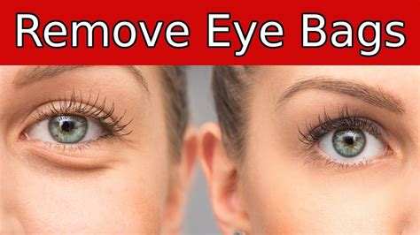 Do You Have Under Eye Bags Here Are 3 Simple But Proven Ways To Get