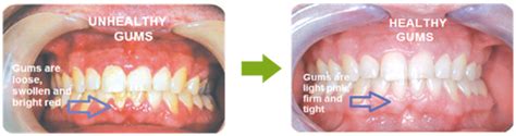 Healthy Vs Unhealthy Gums