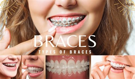 Braces Types Of Braces Braces Without Wire All You Need To Know