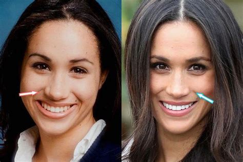 Meghan Markle Plastic Surgery Nose Job Teeth Before And After