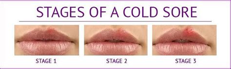 Managing A Cold Sore Outbreak Allure Medical