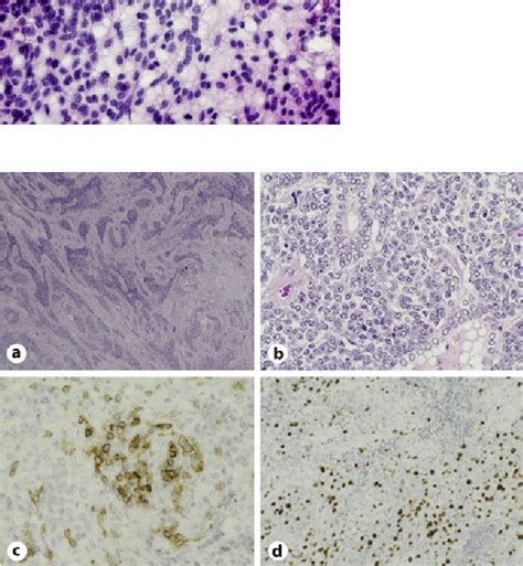 Figure 3 From A Rare Case Of Thyroid Carcinoma Showing Thymus Like