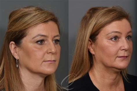 Mid Facelift Before And After Photo Gallery Serving Rochester Syracuse