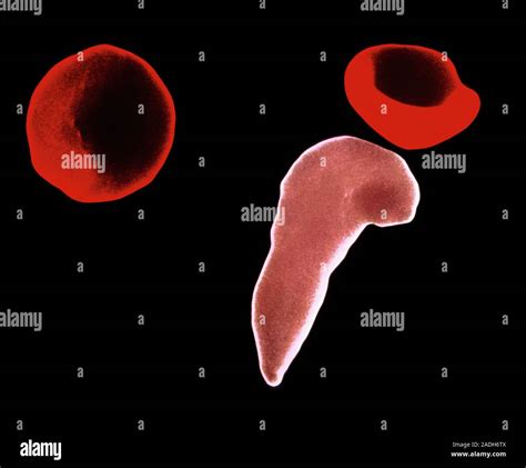 Sickle Cell Anaemia Coloured Scanning Electron Micrograph Sem Of Red