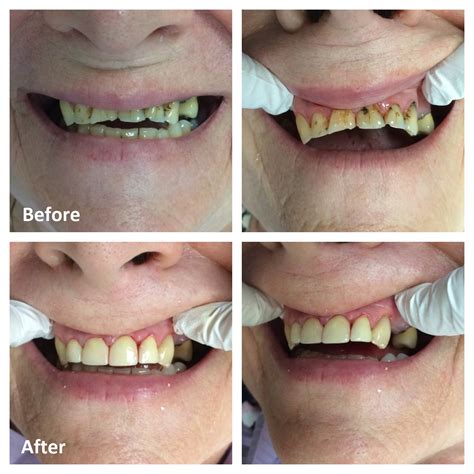 White Fillings Ottawa Tooth Colored Composite Fillings