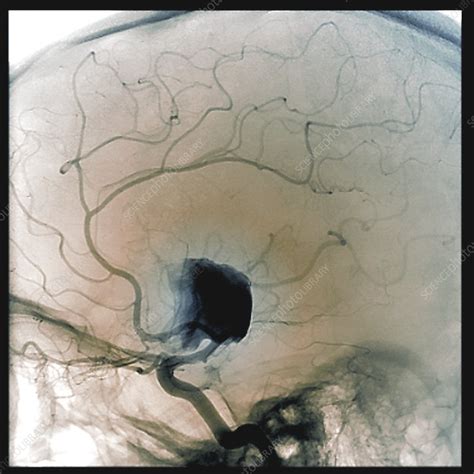 Cerebral Aneurysm Angiogram Stock Image C0388800 Science Photo