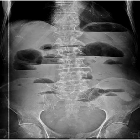 Abdominal Plain X Ray Film An Ileus Pattern With Distended Small Bowel