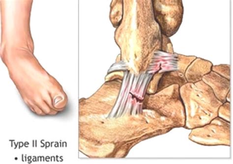 Sprained Ankle Treatment In Dubai Uae Treat Torn Or Twisted Ankle
