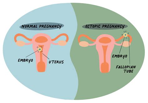 Ectopic Pregnancy Agape Womens Services