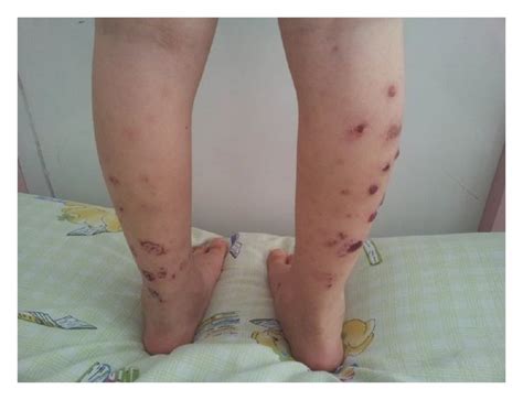 Palpable Purpura And Hemorrhagic Bullae On Both Lower Extremities