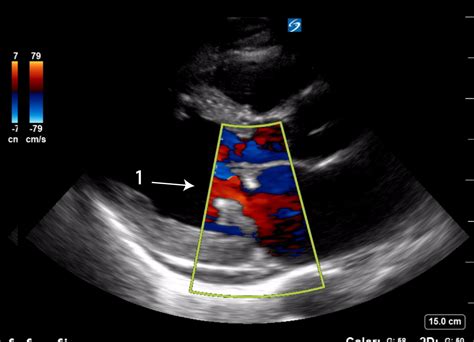 Bacterial Endocarditis Mitral Valve Critical Care Sonography