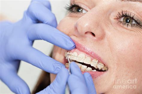 Orthodontist Tightening Braces Photograph By Microgen Images Science Photo Library Fine Art