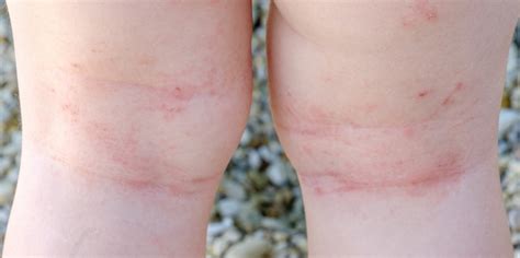 Dermatite Atopica Nei Bambini Sintomi Cause Rimedi E Trattamenti