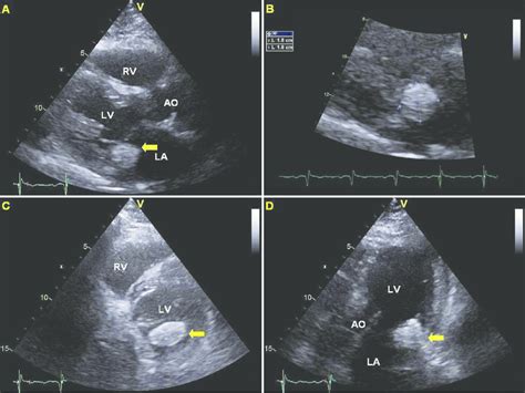 Panel A Transthoracic Echocardiogram Tte Parasternal Long Axis