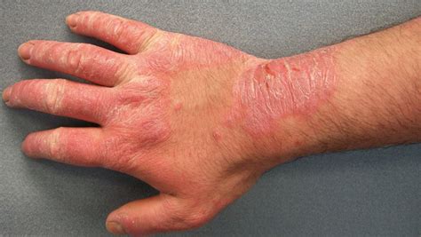 In some cases, the condition will not always be. Types of Skin Diseases That May Attack Human