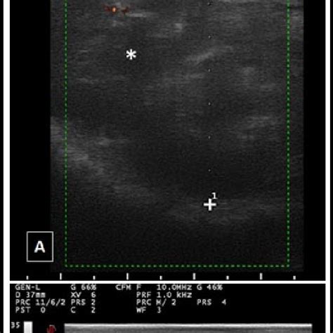 Patient 2 Ultrasound Image High Resolution Imaging Of The Left Carpal