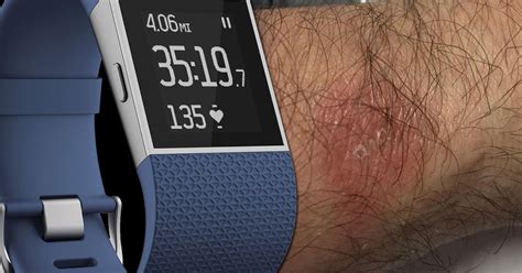 Fitbit Wristband Rash Is Back Again Company Admits Wearing It Too Tightly Can Cause Irritation