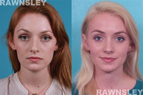 Rhinoplasty Before After Rawnsley Plastic Surgery Rhinoplasty