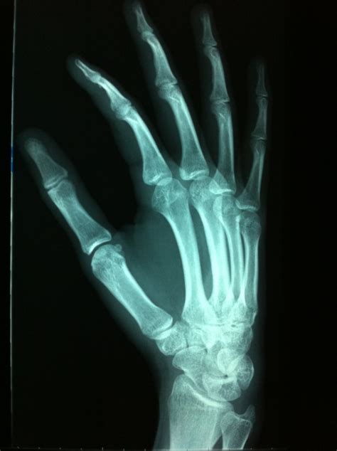 Ulnar Sided Handwrist Pain For Over 6 Months What Is It Thread