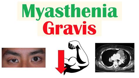 Myasthenia Gravis Pathophysiology Signs Symptoms Diagnosis