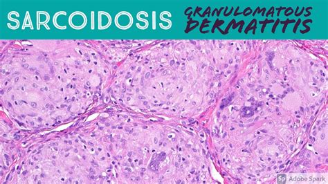 Sarcoidosis And Granulomatous Dermatitis Pattern Inflammatory