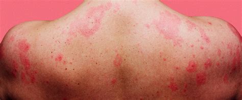 What Are Stress Hives And Rashes And How Do I Treat Them Sexiz Pix