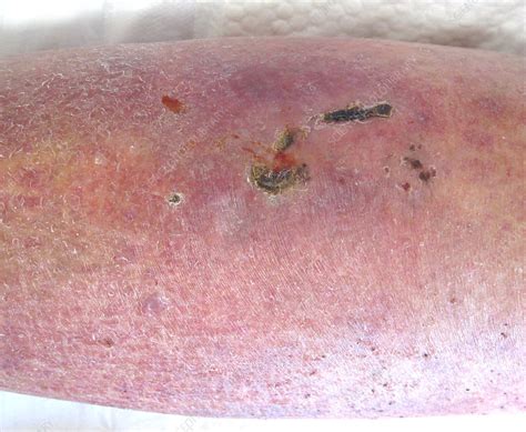 Cellulitis On Shin Stock Image C0094810 Science Photo Library