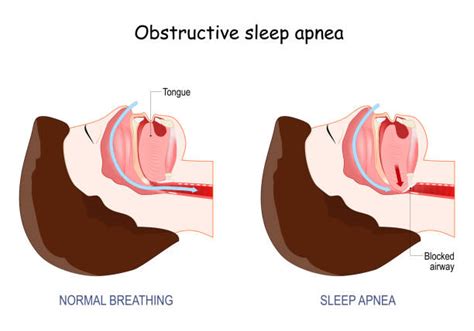ऑब्सट्रक्टिव स्लीप एपनिया क्या है obstructive sleep apnea in hindi health and science