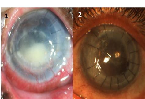 Figure 1 From Streptococcus Mitisoralis Corneal Ulcer After Corneal