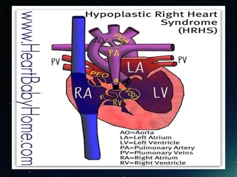 Case Presentation Hypoplastic Right Heart