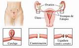 Images of How Do Doctors Treat Endometriosis