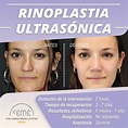 Rinoplastia ultrasónica antes y después en Centro Ceme