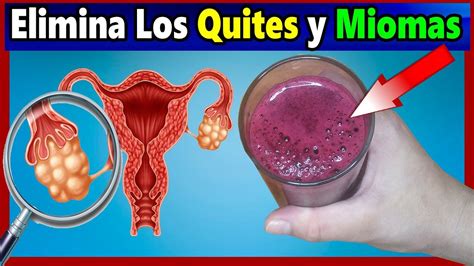 Remedios Naturales Para Quistes De Ovarios Y Miomas