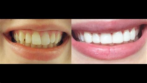 How do you pull a loose tooth? How to get INSTANT STRAIGHT teeth without braces, Veneers ...