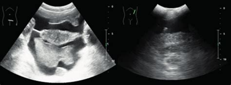 Focused Assessment With Sonography For Trauma Fast Revealed
