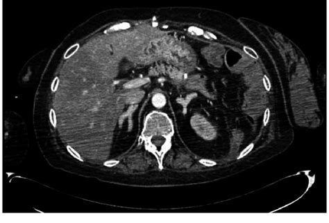 Abdominal Ct Scan Showing Bilateral Adrenal Hyperplasia Secondary To