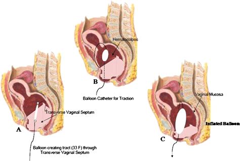 Management Of Transverse Vaginal Septum Using The Olbert Balloon