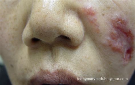 정종영과 메어리벳 Lupus Vulgaris Skin Diseases Images