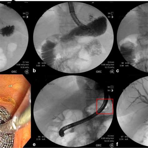 Eus Directed Trans Enteric Ercp Edee For The Management Of Biliary