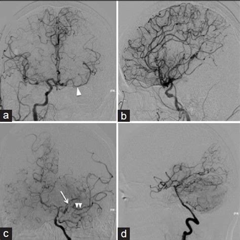 Conventional Angiography Of The Right Internal Carotid Artery A And B