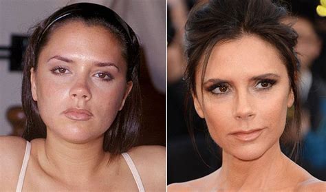 Victoria Beckham Before And After Plastic Surgery Plastic Surgery