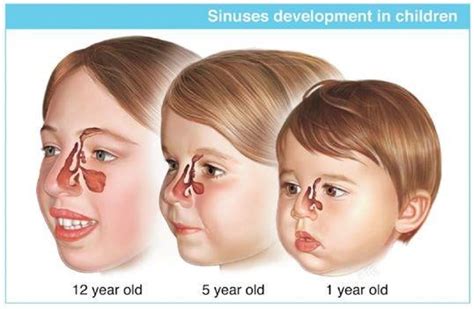 Sheelu Srinivas Ent Practice Sinusitis In Children