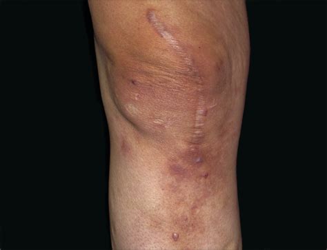 Erythematous Patch Overlying A Swollen Knee—quiz Case Rheumatoid