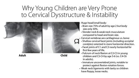 Symptoms And Misdiagnosis Of Cervical Instability In Children